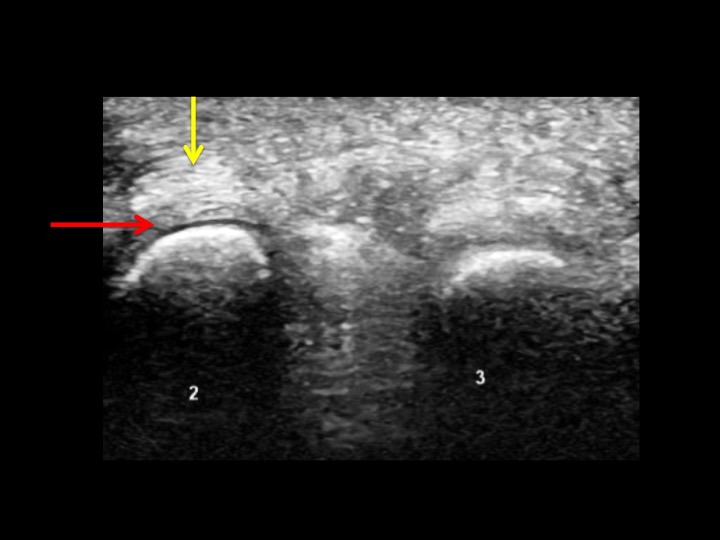 Figure 3 for case plantar plate of metatarsophalangeal joint ( RID3134 )